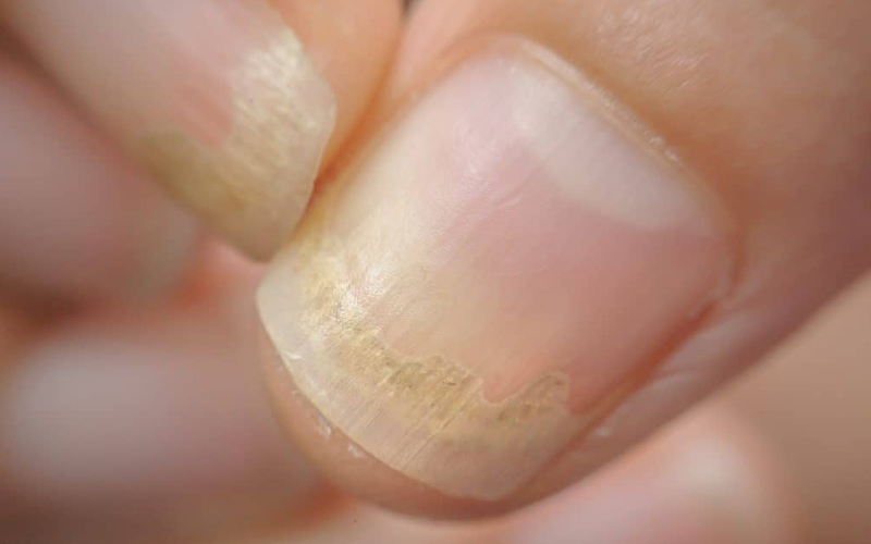 Nail Diseases