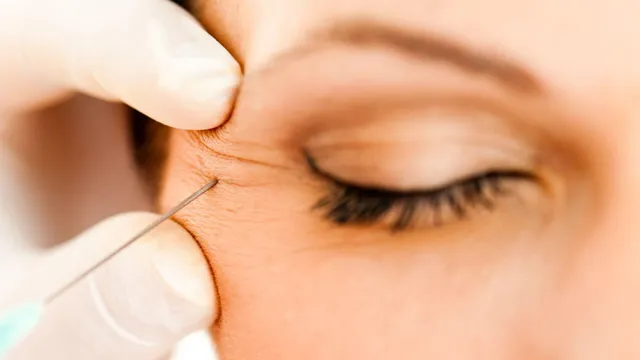 Botox