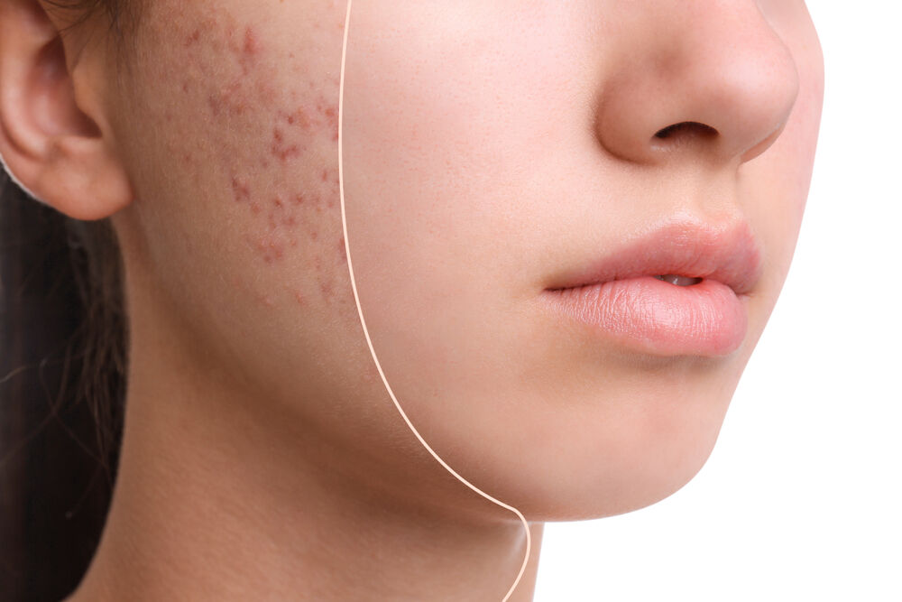 how-to-treat-and-prevent-acne-scars-effectively--expert-guide-from-dr-girish-hubli-thumbnail