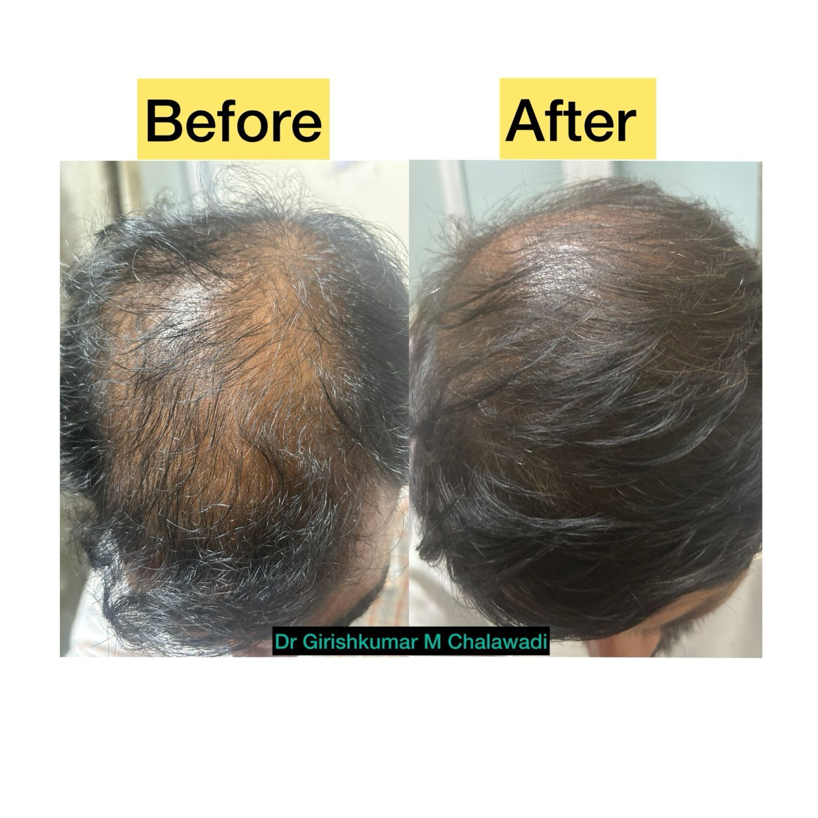 reversing-hair-loss-androgenic-alopecia-treatment-success-in-hubli-north-karnataka-thumbnail