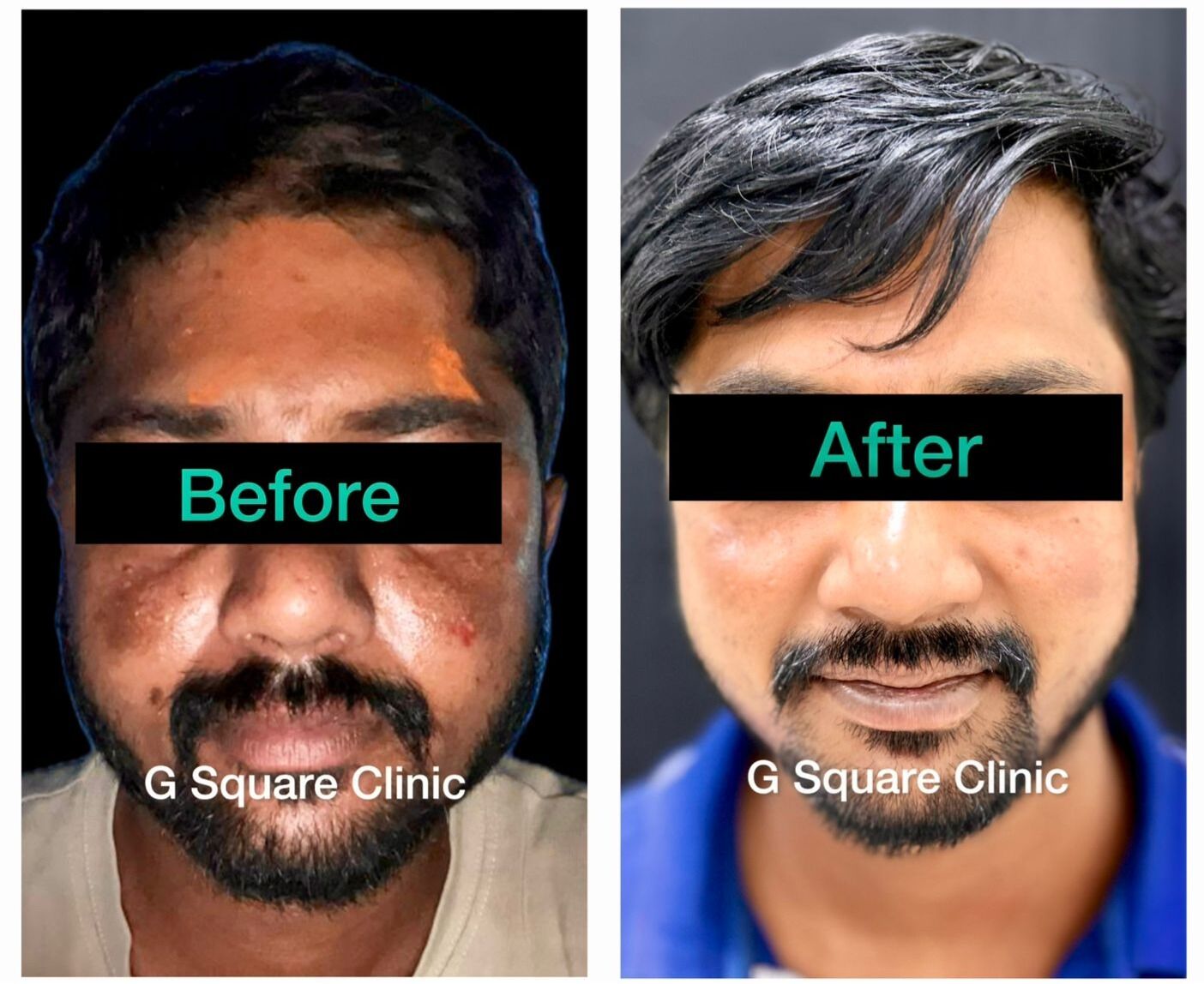 Melasma in Men – A Case of Facial Pigmentation Treated with Chemical Peeling and Laser Toning at G Square Skin & Aesthetics Hubli