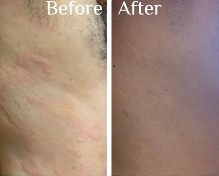 Dramatic Improvement in Urticarial Vasculitis with Oral Colchicine – G Square Skin & Aesthetics, Hubli