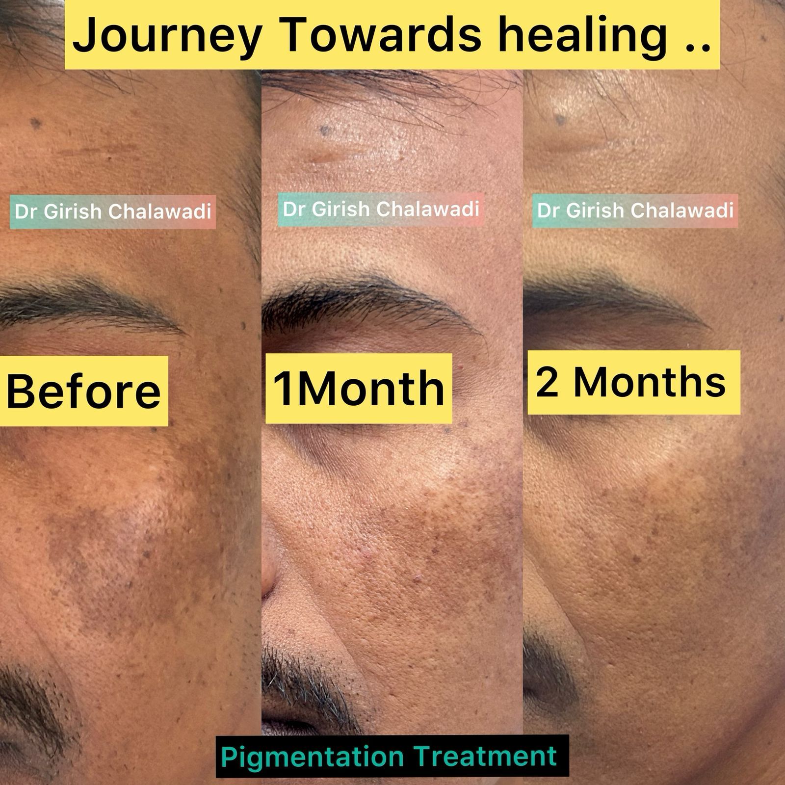 Journey Towards Healing: Transforming Pigmentation with Chemical Peels By Dr. Girishkumar Chalawadi