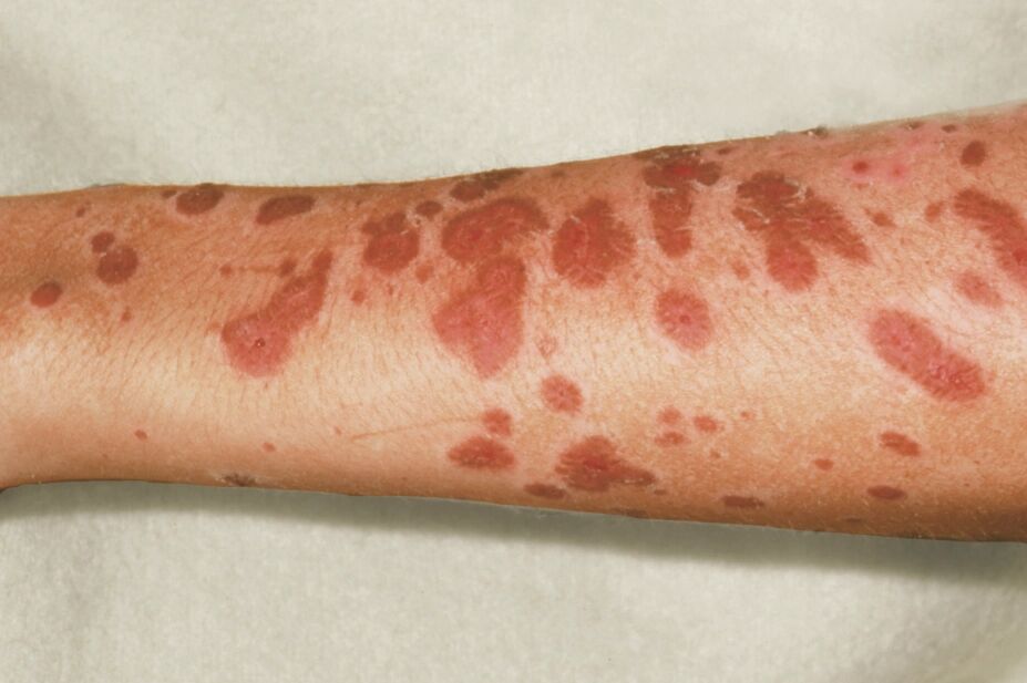 stevensjohnson-syndrome-sjs--a-severe-drug-reaction-successfully-managed-at-g-square-clinic-thumbnail