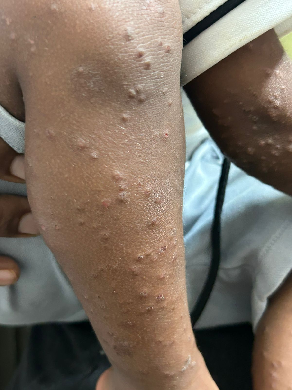 case-of-gianotticrosti-syndrome-papular-acrodermatitis-of-childhood--by-dr-girishkumar-m-chalawadi-thumbnail