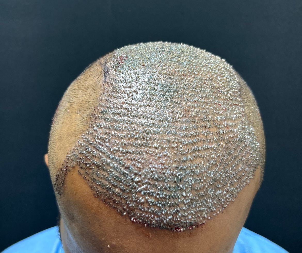 hair-transplantation-a-safe-and-routine-solution-for-hair-restoration-by-dr-girishkumar-chalawadi-thumbnail