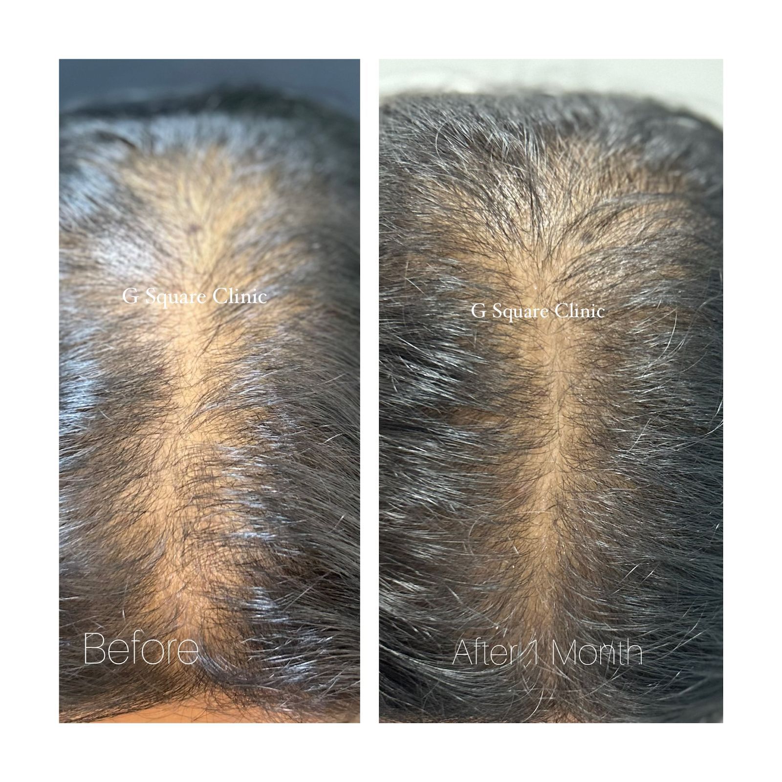 Reclaiming Confidence: How a 24-Year-Old Reversed Severe Hair Loss in Just Three Months