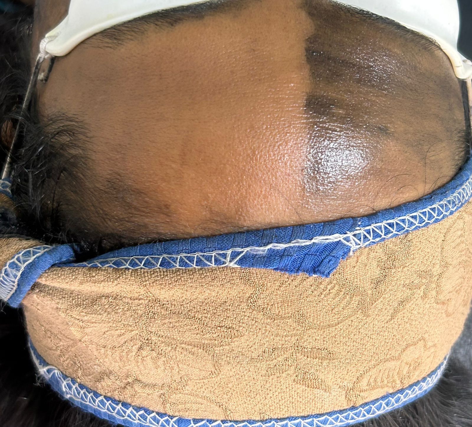 Carbon Peel (Hollywood Facial): The Secret to Instant Glow & Clear Skin | G Square Skin & Aesthetics