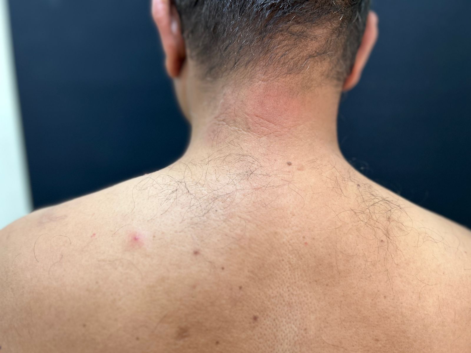 Early Diagnosis Matters: A Case of Borderline Tuberculoid Hansen’s Disease By Dr. Girishkumar Chalawadi