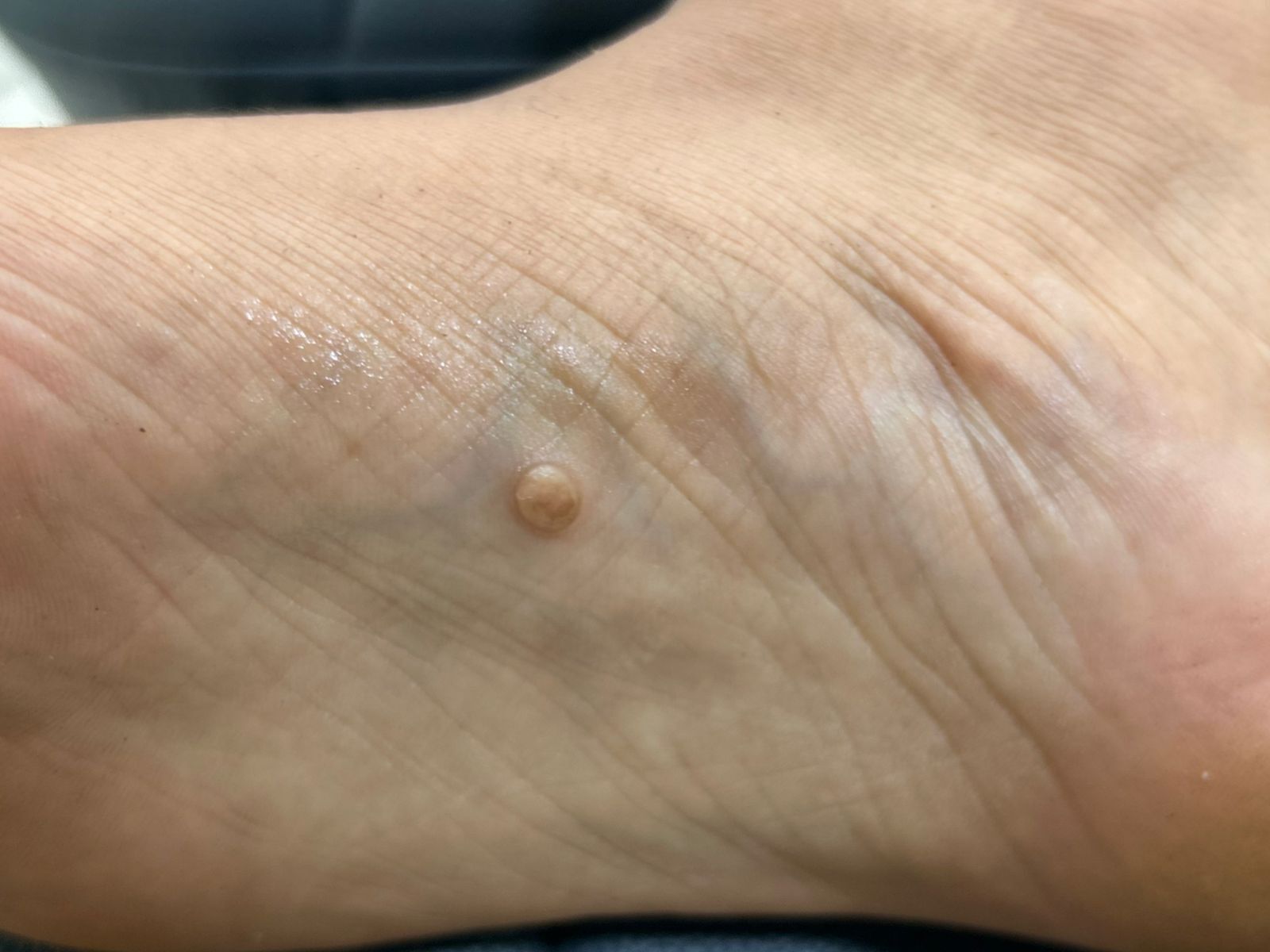 painful-lump-on-the-sole--could-it-be-a-dermatofibroma-by-dr-girishkumar-chalawadi-thumbnail
