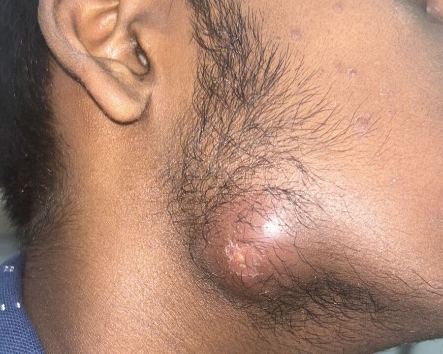 from-simple-acne-to-abscess-a-neglected-case-of-nodulocystic-acne-by-dr-girishkumar-chalawadi-thumbnail