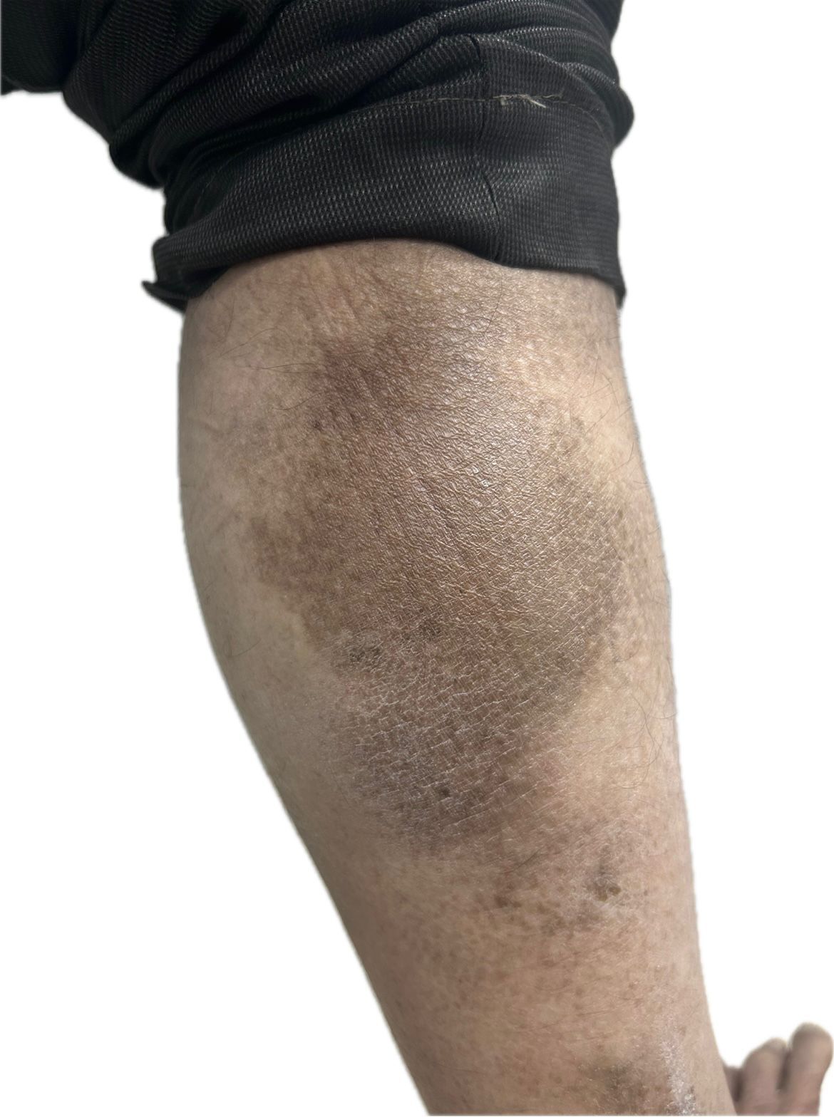 Early Detection of Rare Skin Cancer: Patch Stage Mycosis Fungoides Case Study By Dr. Girishkumar Chalawadi