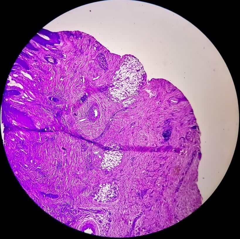 A 25-Year Struggle Finally Diagnosed: A Rare Case of Palmoplantar Porokeratosis by Dr. Girishkumar Chalawadi