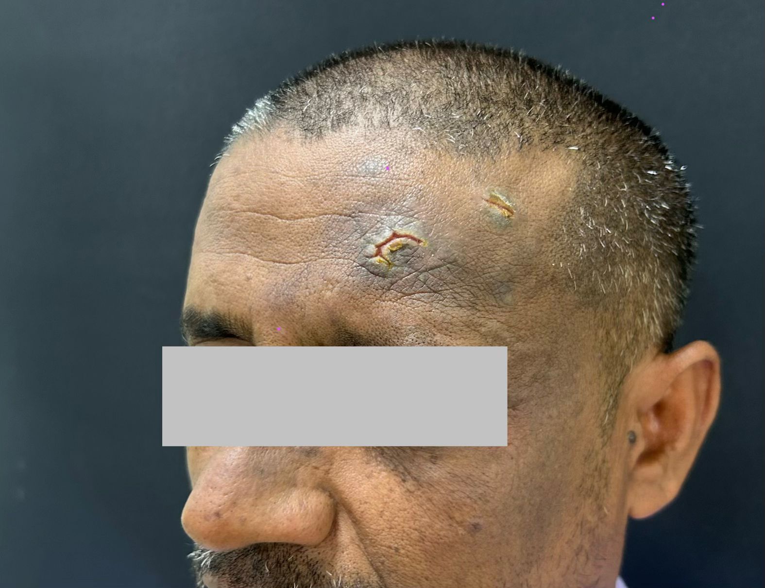 Trigeminal Trophic Syndrome Masquerading as a Skin Ulcer: A Diagnostic Challenge