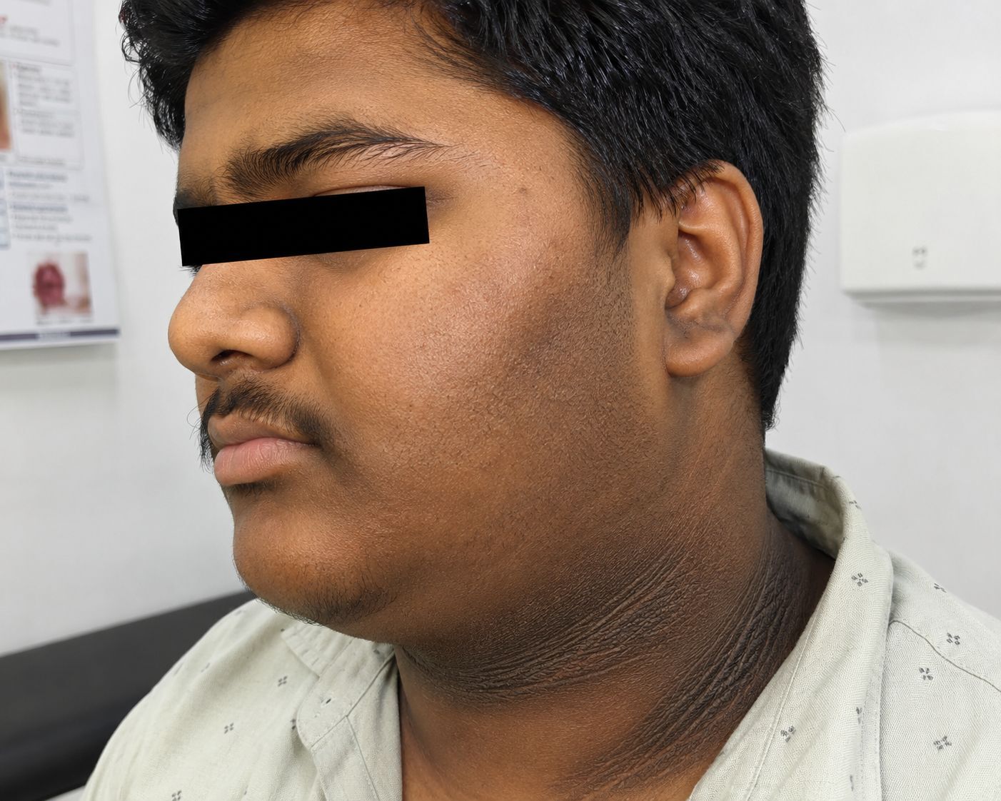 Dark Neck? It Could Be More Than Just Dirt — Understanding Acanthosis Nigricans